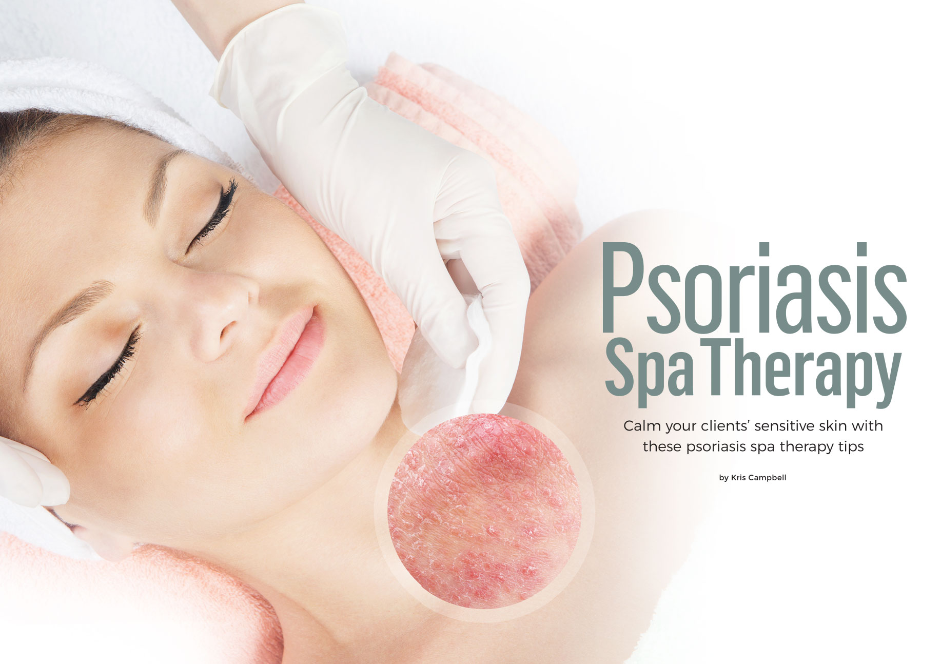 Psoriasis_LNE_2