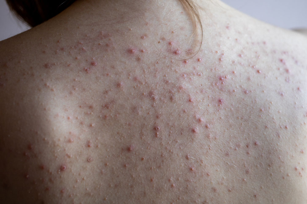 June_blog_pic_bacne June_blog_pic_bacne